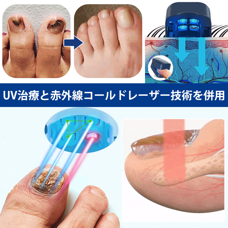 爪真菌対策レーザー治療器