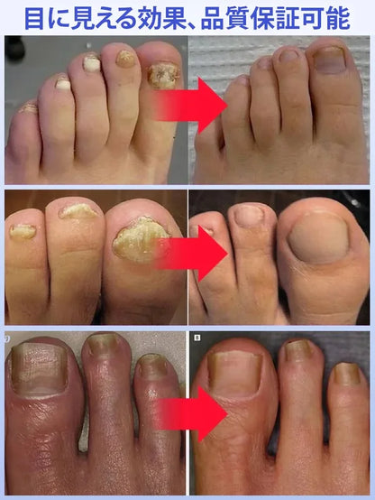 【14日間で爪水虫を根治】爪白癬対策の殺菌消毒水虫薬