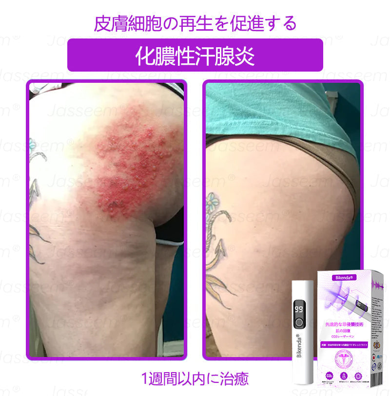 Bikenda® 高性能CO₂レーザーペン 🛫（痛みなし・面倒なしで、イボ・ほくろ・シミ・小さな肌のふくらみをやさしく除去！）お肌のケアにおすすめの非侵襲的アイテムだよ！