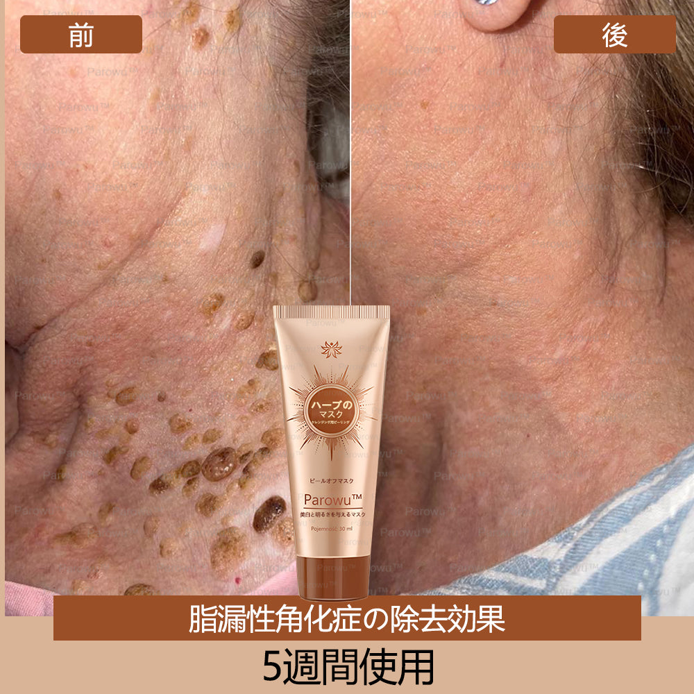 Parowu™シミ・色素沈着除去＆美白マスク(✨天然成分でシミ、色素沈着、日焼けによるシミを長期的にケア)
