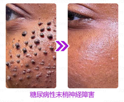 Bikenda® 高性能CO₂レーザーペン 🛫（痛みなし・面倒なしで、イボ・ほくろ・シミ・小さな肌のふくらみをやさしく除去！）お肌のケアにおすすめの非侵襲的アイテムだよ！