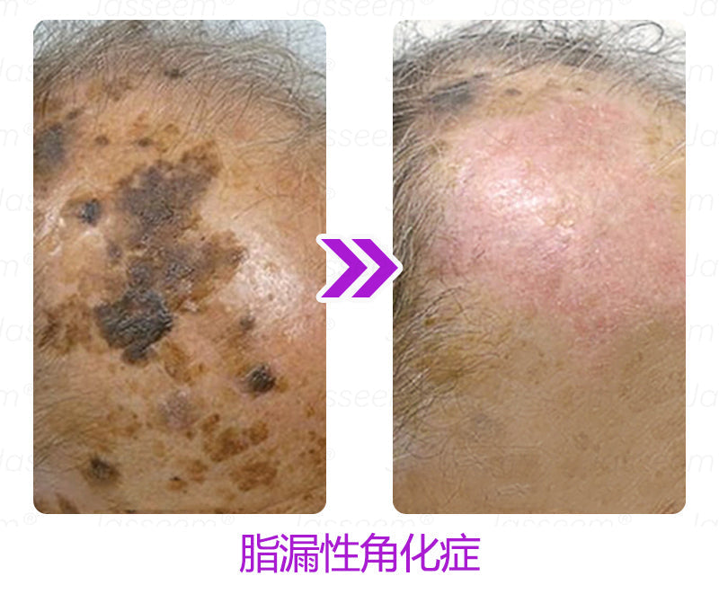 Bikenda® 高性能CO₂レーザーペン 🛫（痛みなし・面倒なしで、イボ・ほくろ・シミ・小さな肌のふくらみをやさしく除去！）お肌のケアにおすすめの非侵襲的アイテムだよ！