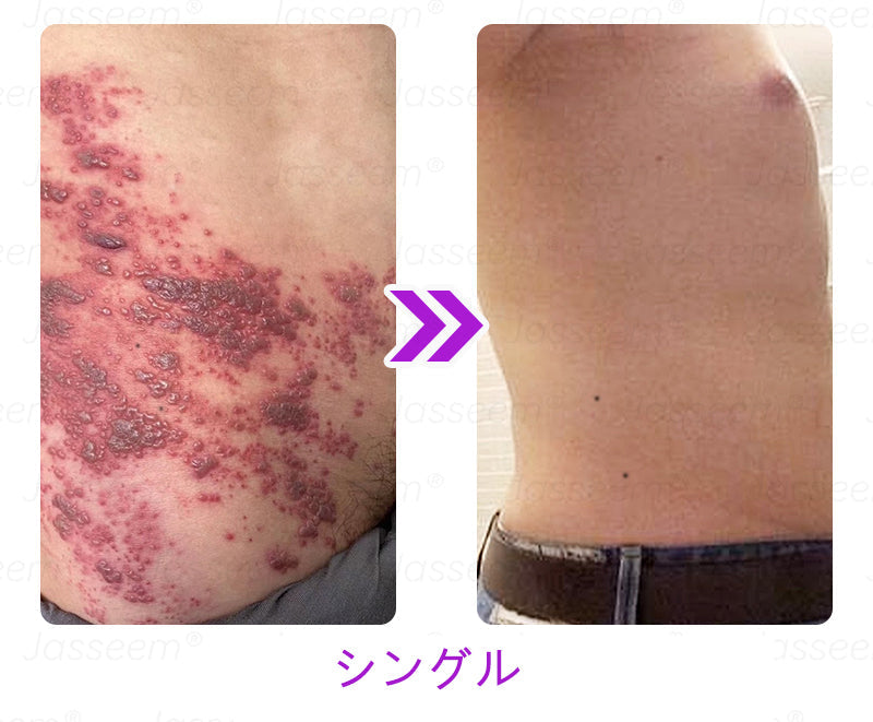 Bikenda® 高性能CO₂レーザーペン 🛫（痛みなし・面倒なしで、イボ・ほくろ・シミ・小さな肌のふくらみをやさしく除去！）お肌のケアにおすすめの非侵襲的アイテムだよ！