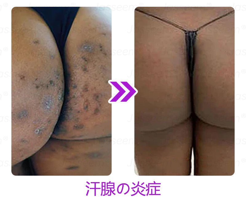 Bikenda® 高性能CO₂レーザーペン 🛫（痛みなし・面倒なしで、イボ・ほくろ・シミ・小さな肌のふくらみをやさしく除去！）お肌のケアにおすすめの非侵襲的アイテムだよ！