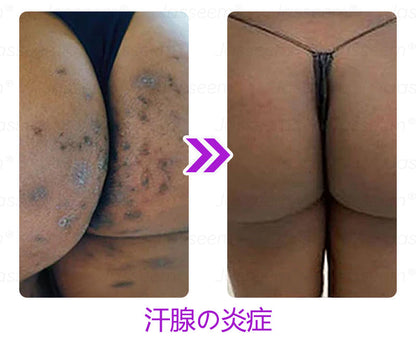 Bikenda® 高性能CO₂レーザーペン 🛫（痛みなし・面倒なしで、イボ・ほくろ・シミ・小さな肌のふくらみをやさしく除去！）お肌のケアにおすすめの非侵襲的アイテムだよ！