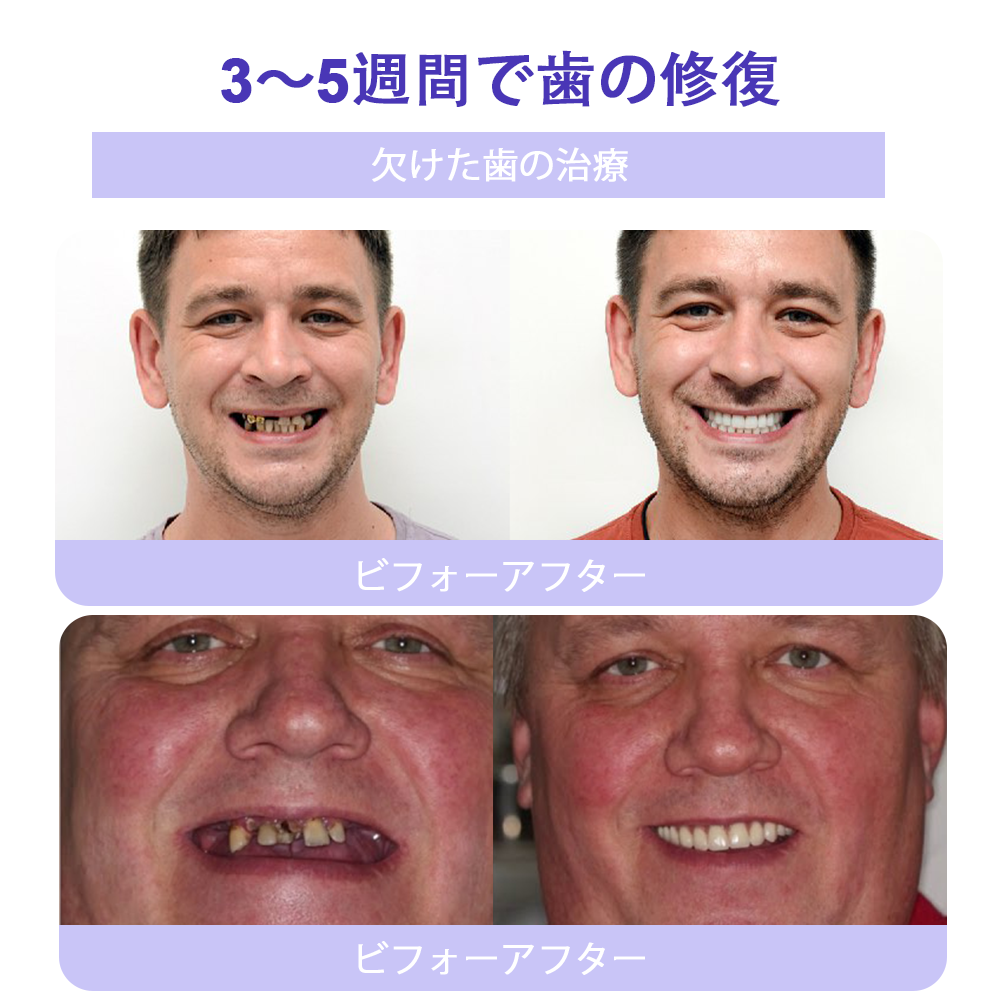 Cvreoz®🎁（ADA推奨）ミネラル歯修復パウダー 🦷 残り30分限定！特別割引実施中 🦷