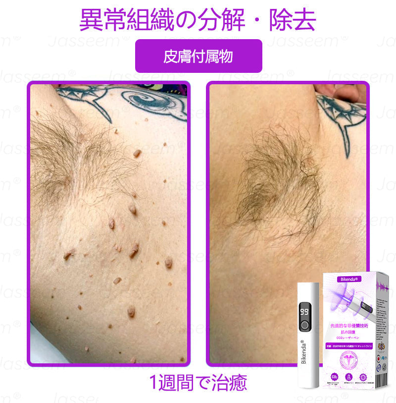 Bikenda® 高性能CO₂レーザーペン 🛫（痛みなし・面倒なしで、イボ・ほくろ・シミ・小さな肌のふくらみをやさしく除去！）お肌のケアにおすすめの非侵襲的アイテムだよ！