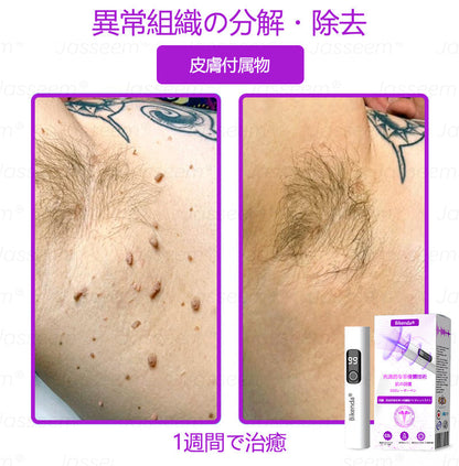 Bikenda® 高性能CO₂レーザーペン 🛫（痛みなし・面倒なしで、イボ・ほくろ・シミ・小さな肌のふくらみをやさしく除去！）お肌のケアにおすすめの非侵襲的アイテムだよ！