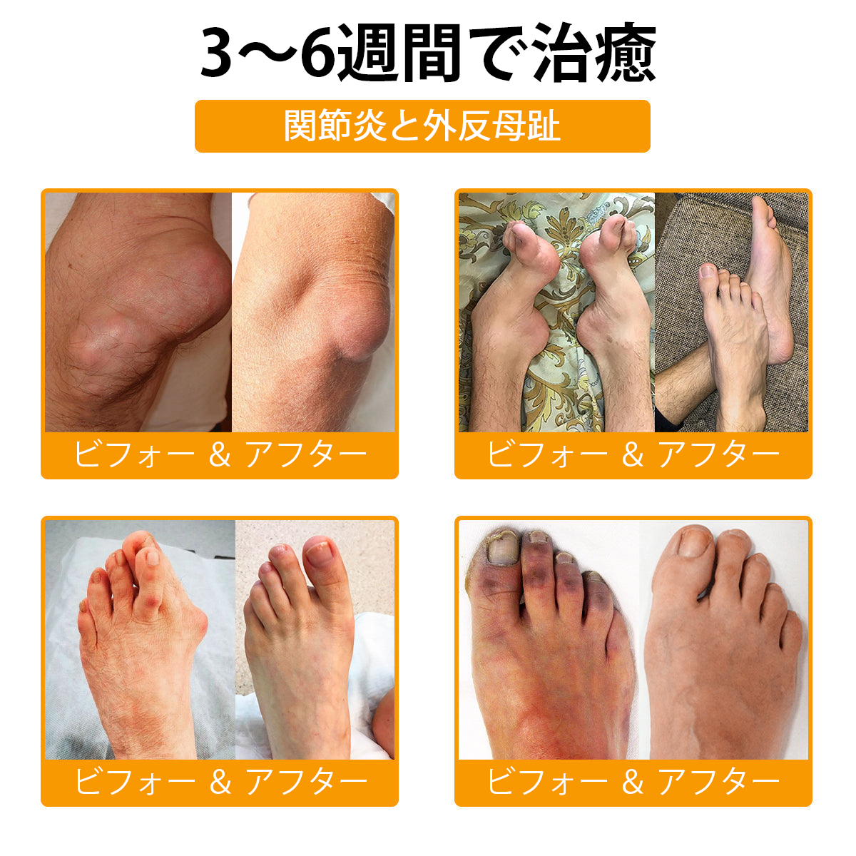 WarmFamily® ボツリヌストキシン＆蜂毒配合 骨治癒促進鎮痛クリーム🐝