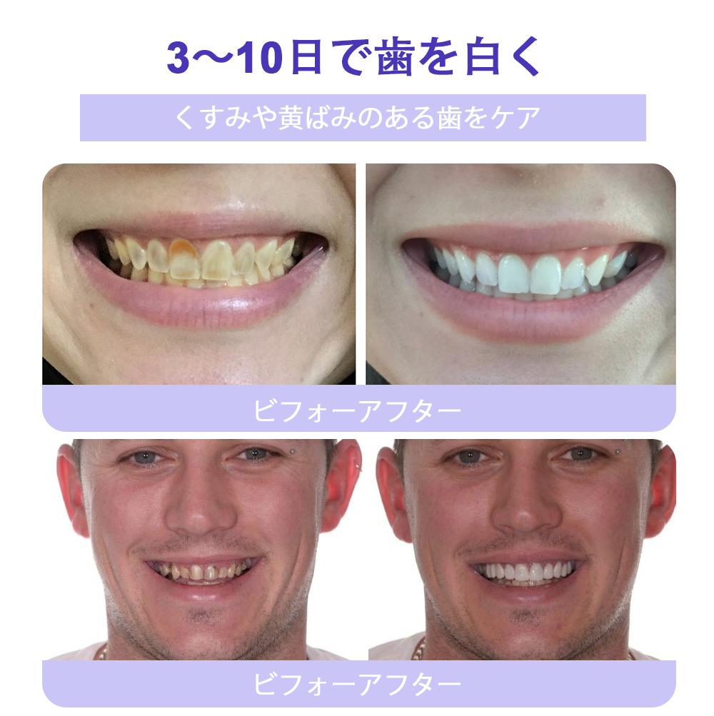 Cvreoz®🎁（ADA推奨）ミネラル歯修復パウダー 🦷 残り30分限定！特別割引実施中 🦷