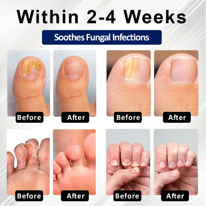 ATTDX® Fungiclear Bee Therapy Nail Spray