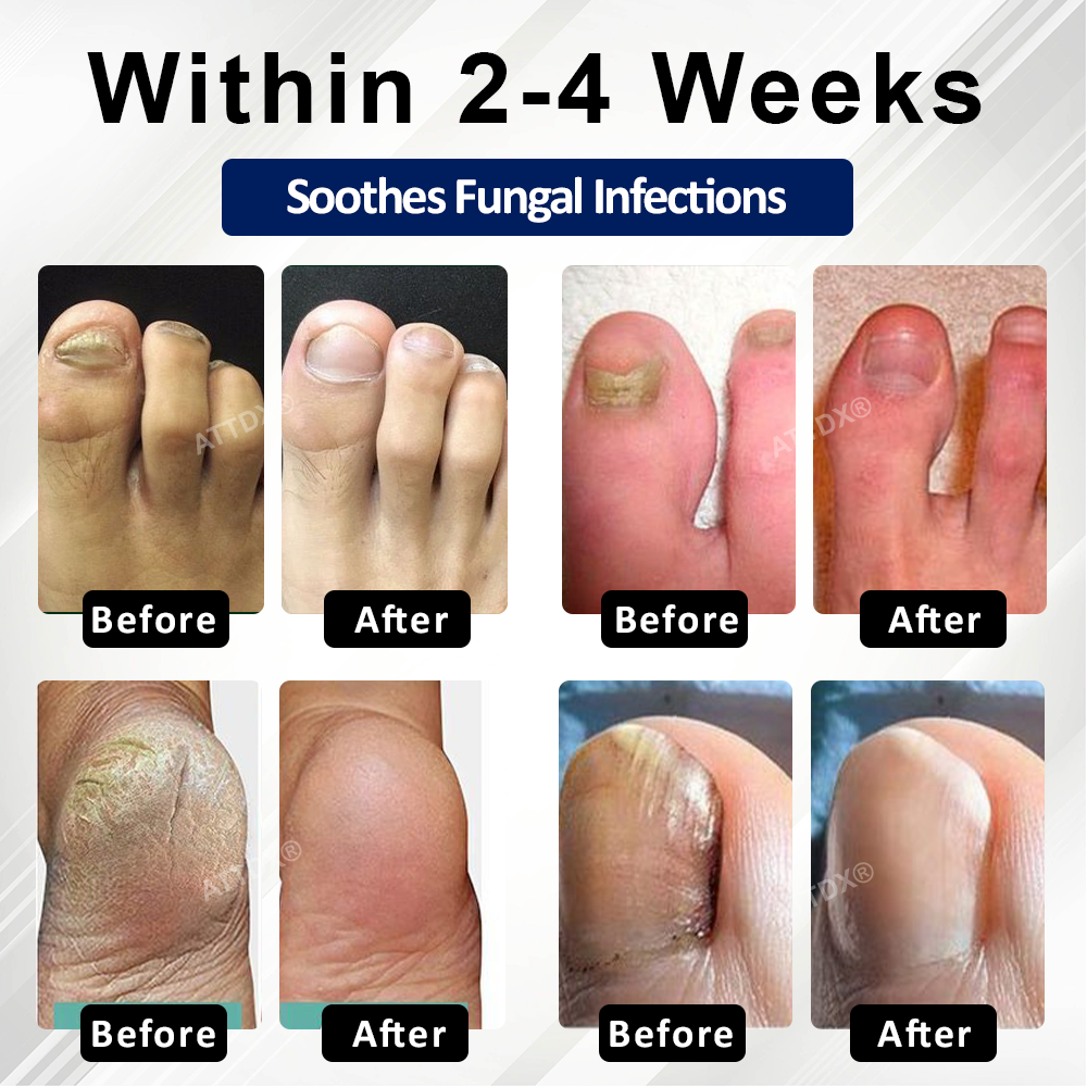 ATTDX® Fungiclear Bee Therapy Nail Spray