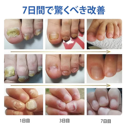 爪真菌対策レーザー治療器