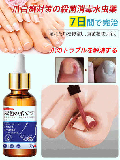 【14日間で爪水虫を根治】爪白癬対策の殺菌消毒水虫薬